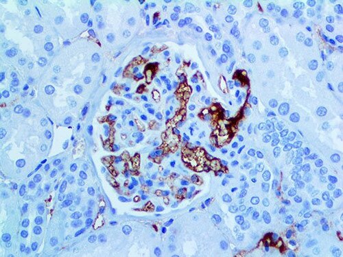 IHC of IgM on an FFPE Axilar Lymph Node with Metastatic Breast Carcinoma